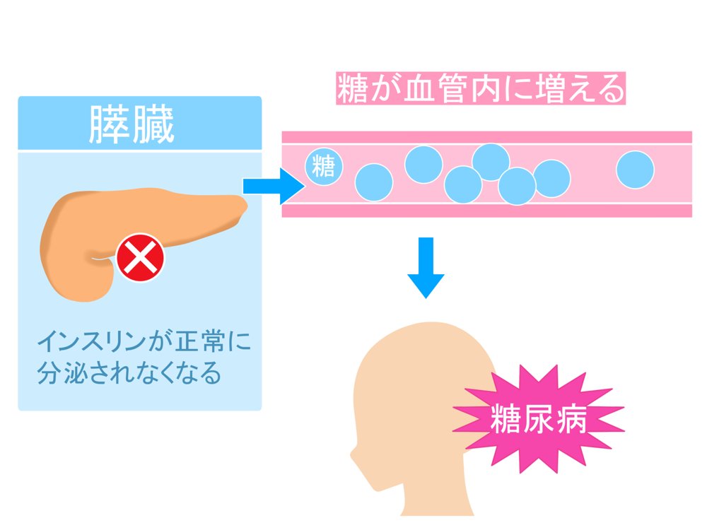 糖尿病・血糖値異常のイメージ