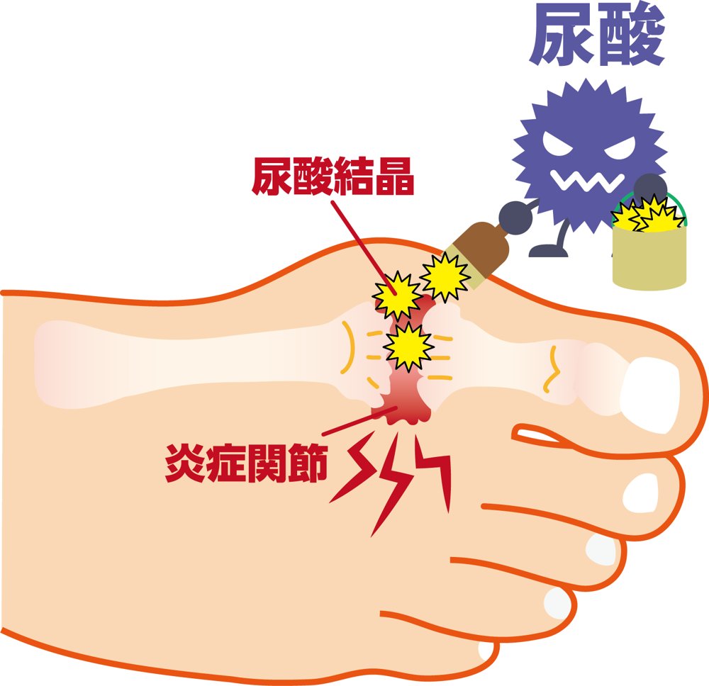 高尿酸血症・痛風のイメージ
